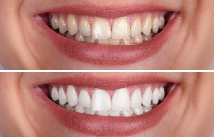 common mistakes to avoid when whitening your teeth