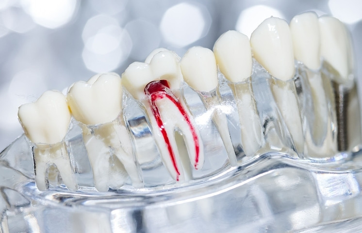 signs that indicate you might need root canal
