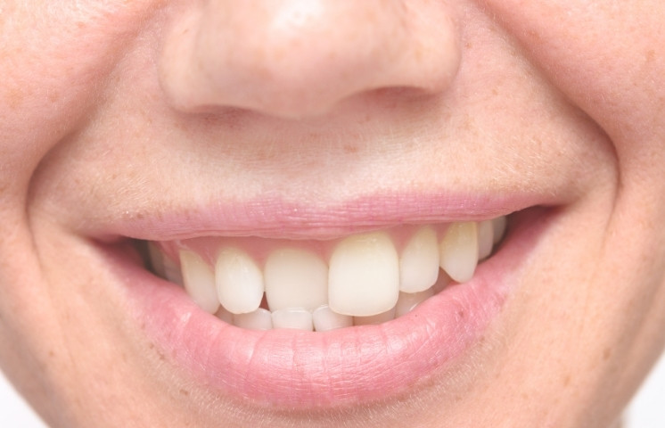 how to fix your slightly shifted teeth